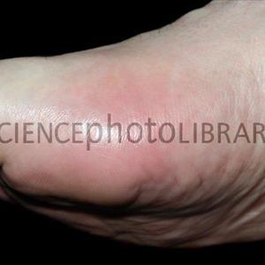 Information And Treatment Of Gout - Gout Is Painful And Treatment Is Essential