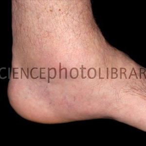 Goutzol - Gout Symptoms And Some Great Herbal Medicines For Gout