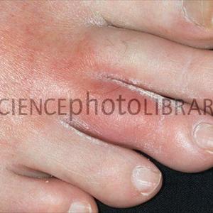 Gout Exer - Remedies For Gout You Should Know