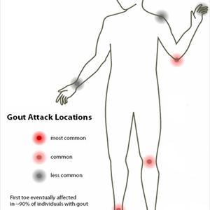 List Of Fruits With Uric Acid - Revealing Gouty Arthritis Amongst Others Is Hard Employment : An Appraisal