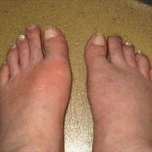 Gouts Problems - How Gout Remedy Is Able To Help The Condition