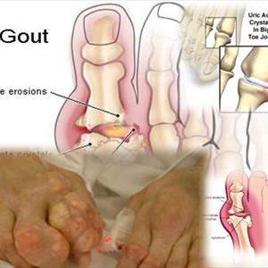 Celery Gout Cure - Frankincense Is A Natural Arthritis And Gout Treatment