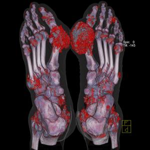 Juices Good For Uric Acid - Cause Of Gout Could Also Predict Cardiovascular Failure