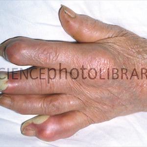 Gout Treatments - Acidity Remedies