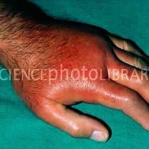 Allopurinol And Alcohol Use - Do You Think Apple Cider Vinegar Treatment Is The Perfect Solution Regarding Gout?