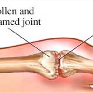 Uric Acid Salmon - High Uric Acid Symptoms How An Increase In Uric Acid Can Cause Gout