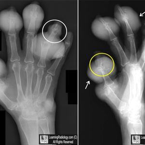 How Long Does Gout Attack Last In The Knee - Best Natural Foods And Naturopathic Solutions For Gout - How To Get Started