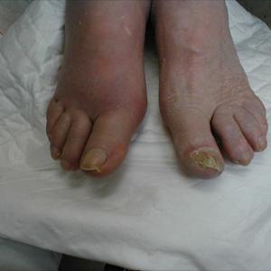 Goutezol Gout Relief - Simple And Potent Home Gout Remedy