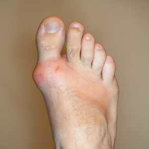 Gout Heat - Gout Diet