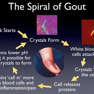 Stop Gout Attack - All You Need To Know Concerning Treating Gout In A Easier Way