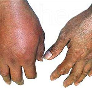 Gout And Cheese - Home Remedies To Relieve Pain Of Arthritis