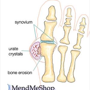 Anti Gout Medicines - What Is Actually The Ultimate Way To Control Gout Problem?