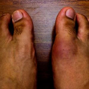 Gout Morecondition_Treatment - A Research On The Symptoms And Factors Behind Gouty Arthritis