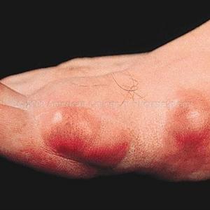 Is There A Safe Herbal Alternative To Allopurinol - Diet For Gout Sufferers - Safe And Helpful Tips