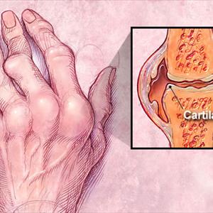 Mulberry Tea Uric Acid - Gout